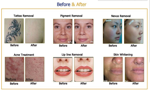  808 Diode Laser Hair Removal Yag 755 808 1064 Diode Laser Hair Removal Machine