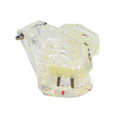 Full Dental Implant Model Removable Bridge Disease Prevention Oral Health