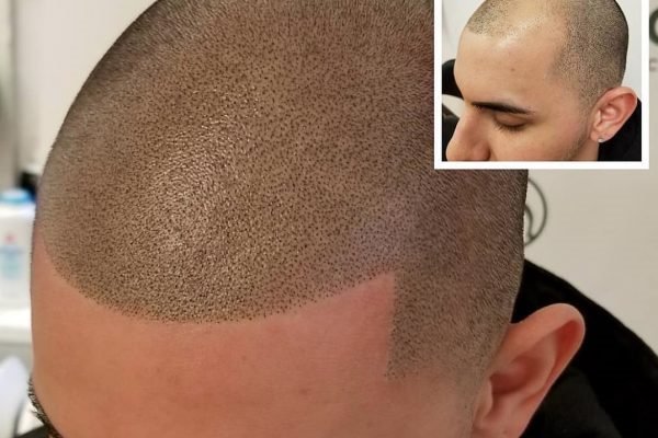 Tattoo Removal Ipl Hair Removal Skin Tag Removal Scalp Micro