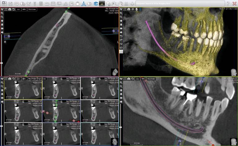 NEW 2018 ACTEON X-Mind Trium 3D CBCT 11x8 FOV w/ 1 YR Manufacturer Warranty