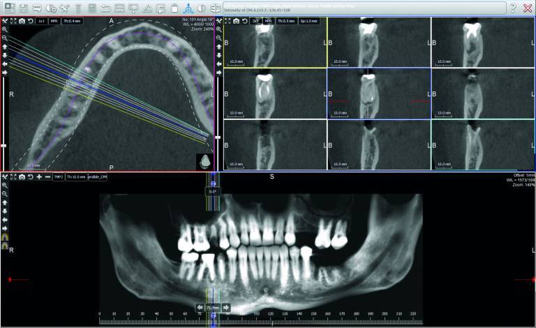 NEW 2018 ACTEON X-Mind Trium 3D CBCT 11x8 FOV w/ 1 YR Manufacturer Warranty