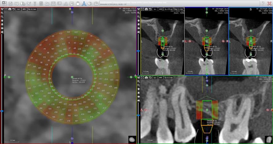 NEW 2018 ACTEON X-Mind Trium 3D CBCT 11x8 FOV w/ 1 YR Manufacturer Warranty