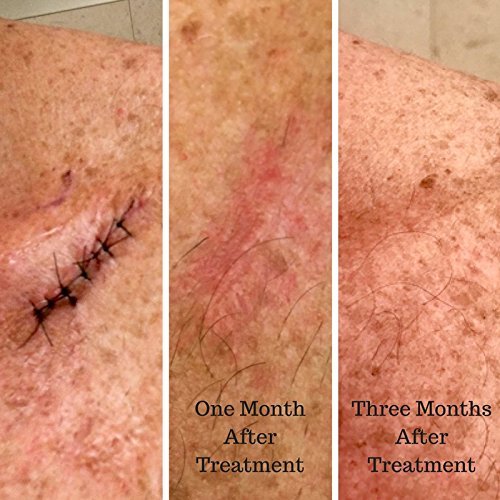 Scarless MD Advanced Silicone Scar Removal with Vitamin E Fades...