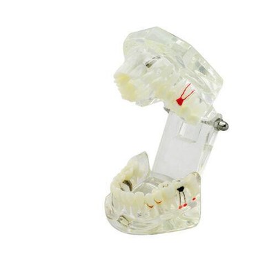 Teeth Restoration Dental Implant Removable Bridge Oral Solution