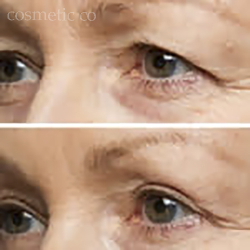 татуаж от кругов под глазами. осветление кругов под глазами. глаз ухоженный. мезотерапия синяки под глазами. осветлить под глазами.