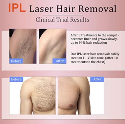 Permanent Hair Removal, MiSMON IPL Laser Hair Removal for Women/Men, at-Home 