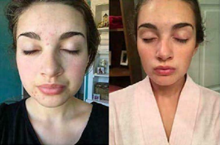Keeva Organics 5-in-1 Essential Oil Clarifying Acne Face Wash - Organic Tea Tree