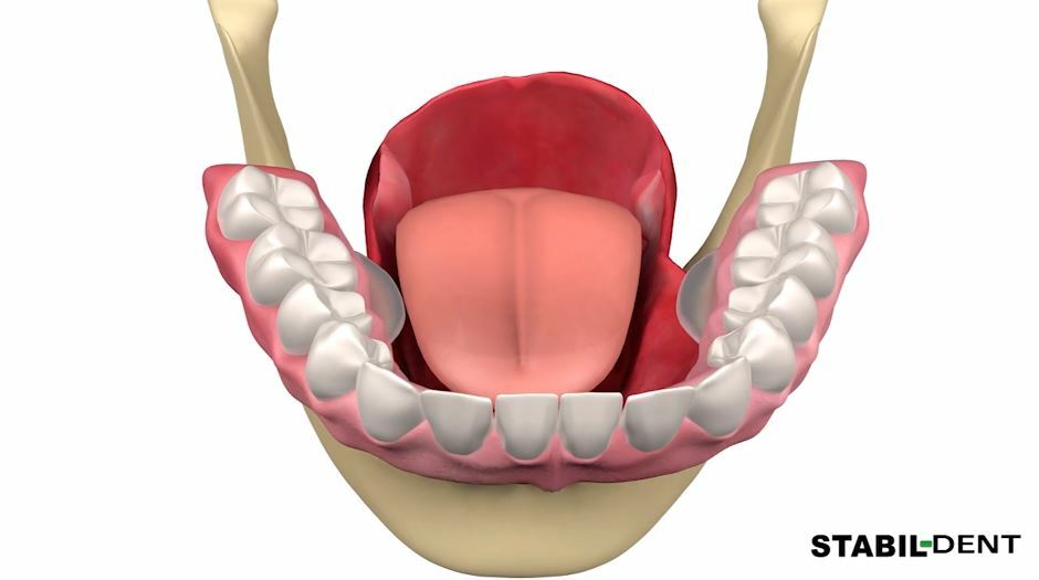 Lower Denture Stabilizers DIY Kit-Affordable Denture Stabilization 