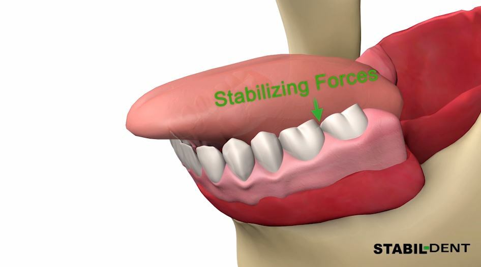 Lower Denture Stabilizers DIY Kit-Affordable Denture Stabilization 
