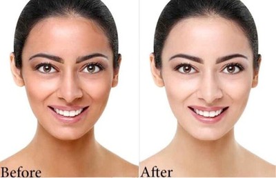 Deoxyarbutin Skin Bleaching Powder Dark Areas - Better than Hydroquinone