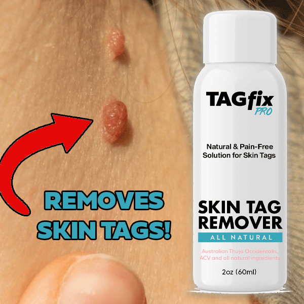 Skin Tag Remover 🙌 Best Skin Tag Removal Fast Acting Discreet Shipping! TAGFIX