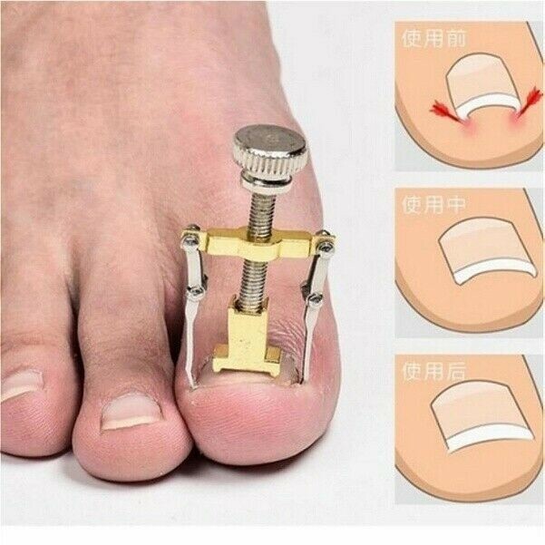 ingrown-toe-nail-correction-pedicure-tool-bend-toenails-support-manicure-shp