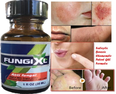 Ointment gel Anti-Fungal SALICYLIC & BENZOIC COMPOUND ECZEMA Wart Antifungal