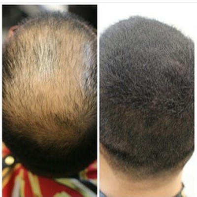 Buy 5x Hair Thickening Fibers By Hair Illusion Bald Thinning Scalp