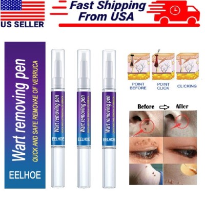 4× Painless Wart Remover Pen Eliminate Skin Tag Foot Corn Mole Warts Restoration