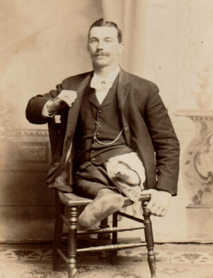 Antique DEFORMED CIRCUS FREAK Rare HUMAN-FROG PHOTO Sideshow