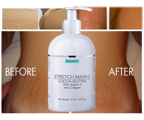 Scar Stretch Mark Reducers Surplus Network