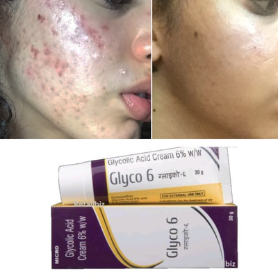 Glyco 6 Glycolic Acid Cream 6 Reduce Acne Hyperpigmentation 30