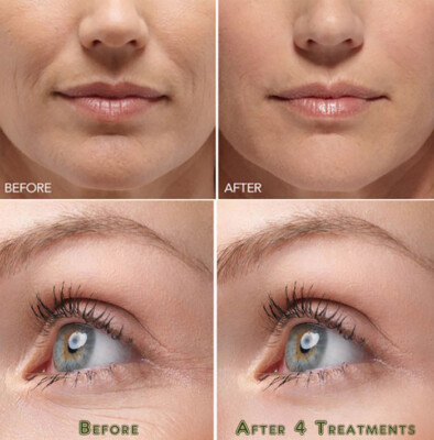 Hyaluronic Acid Gel Cream - Anti-Aging Wrinkle Face & Eye (HA) Serum Moisturizer