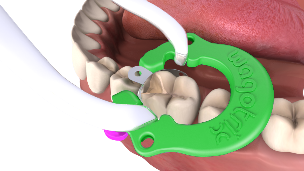 кольцо dentsply palodent 2.