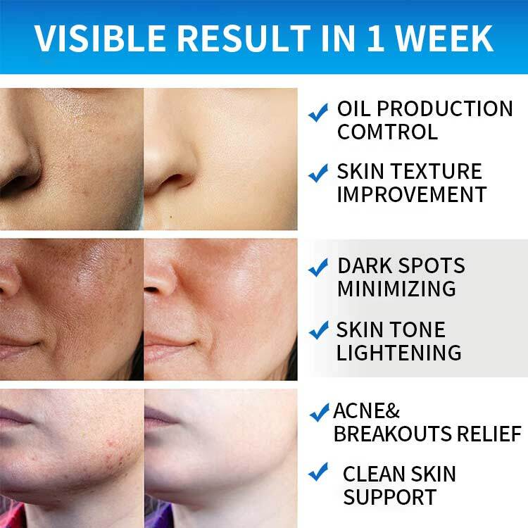 35% Glycolic Acid Facial Exfoliating Peel 50 Pads AHA Green Tea Top Seller Trend