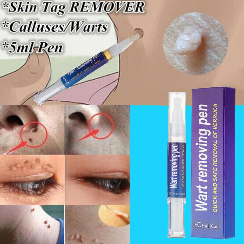12 Hours Wart Remover Pen Skin Tag Mole Remover Eliminate Foot Corn Warts Unisex