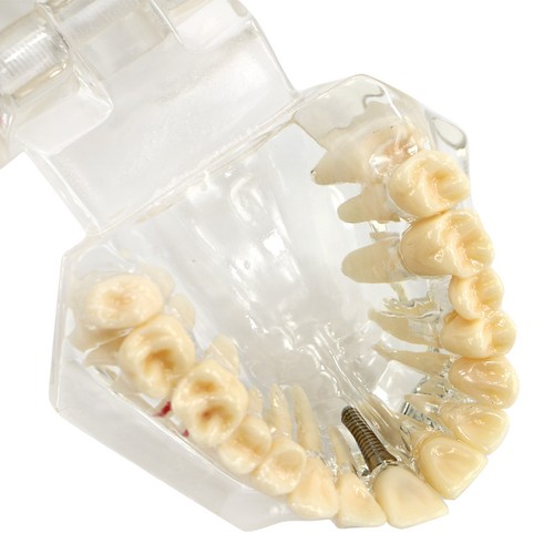 Dental Implant Disease Study Teaching Teeth Model Restoration Bridge Tooth Analy