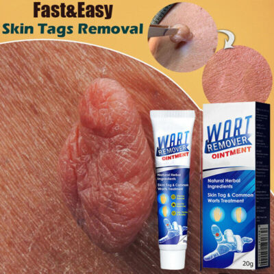 Skin Wart Tag Remover Cream Antibacterial Extract Corn Plaster Warts Ointment US