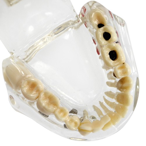 Dental Implant Disease Study Teaching Teeth Model Restoration Bridge Tooth Analy