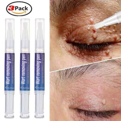 3 Pack 12 Hours Wart Remover Pen Skin Tag Mole Foot Corn Eliminate Warts Unisex