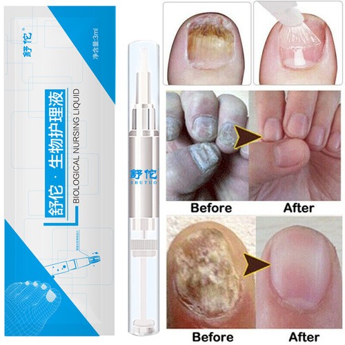 Anti Nagelpilz Stift gegen Nagelpilz Behandlung Pflege 3ml