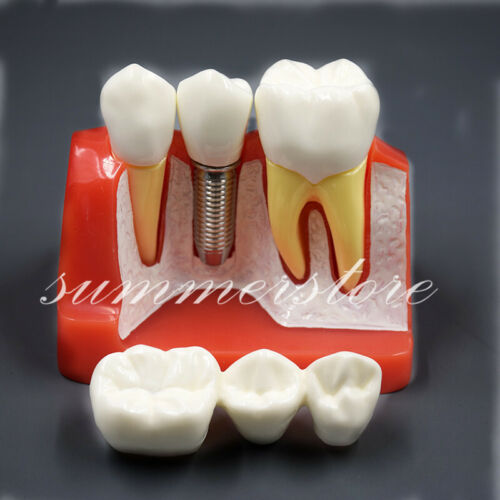 Dental 4 Times Implant Analysis Crown Bridge Demonstration Teeth Tooth Model