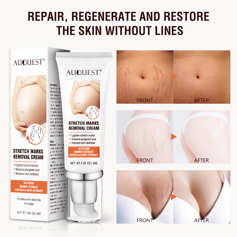 Maternity Scars Acne Cream Pregnancy Stretch Marks Remove Cream 7 Day Effect