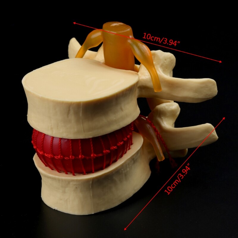 1:1.5 Anatomical Human Lumbar Vertebrae Degenerative Lumbar Spine Model Yellow
