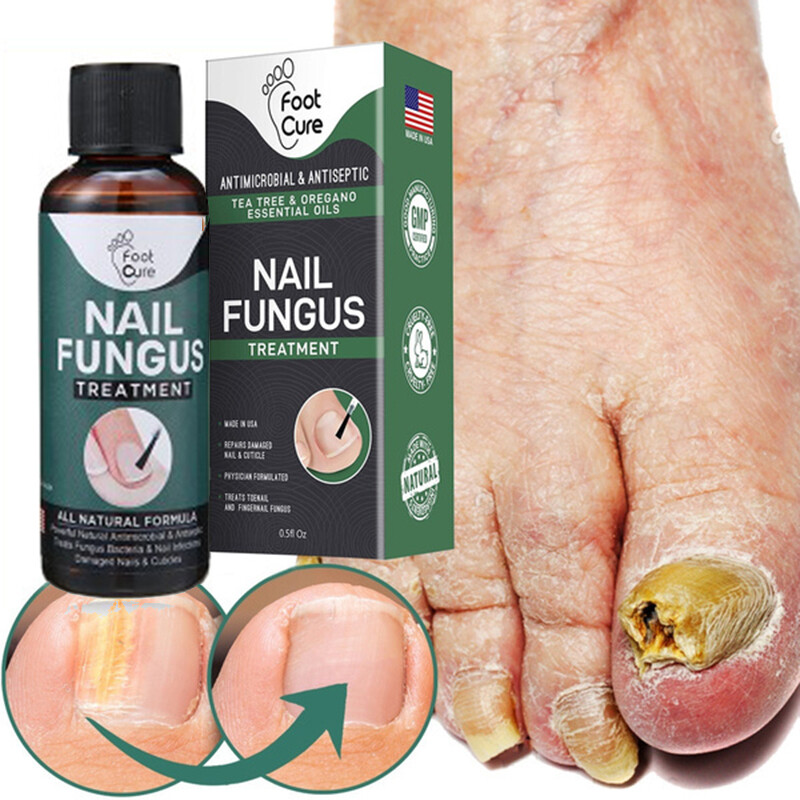 50ml Nagel Pilz Behandlung Anti Pilz Entfernung Zehennagel Fuß Nall Reparatur