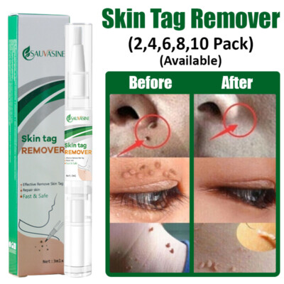 Fast Dark Spot Wart Remover Pen Skin Tag Mole Remover Eliminate Foot Corn Warts