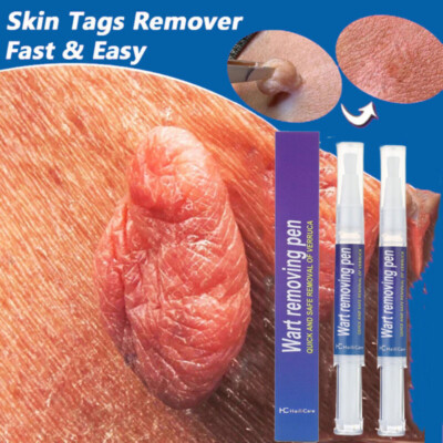 2Pack 12 Hours Wart Remover Pen Skin Tag Mole Remover Eliminate Foot Corn Warts