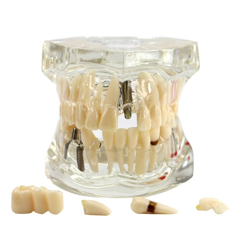 Dental Implant Disease Study Teaching Teeth Model Restoration Bridge Tooth Analy
