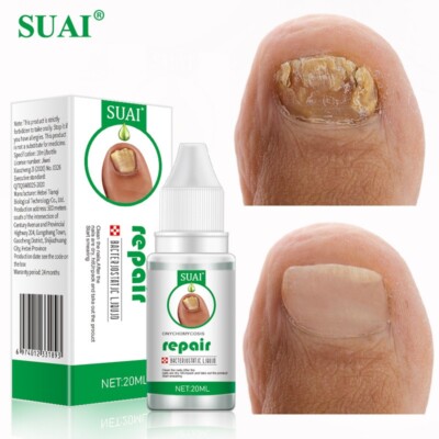Grey Nail Repair Liquid Fungu SUAI Foot Essence Liquid Treatment Paronychia Hand