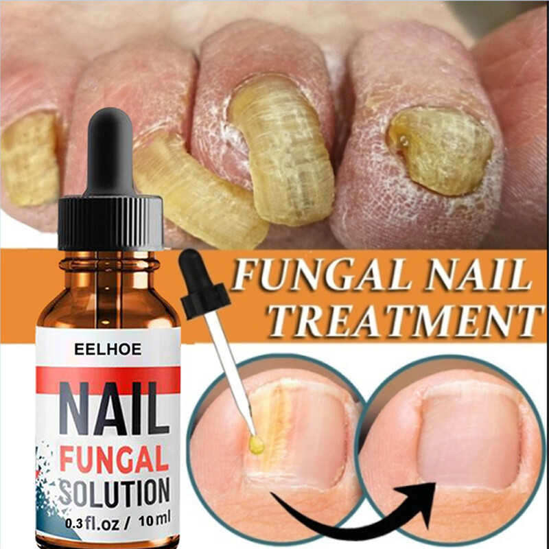 Anti Pilz Nagel Fungal Treatment Reparatur Laser Behandlung Nail Onychomykose