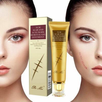  30g Acne Scar Removal Cream Pimples Stretch Marks Gel Remove Nice