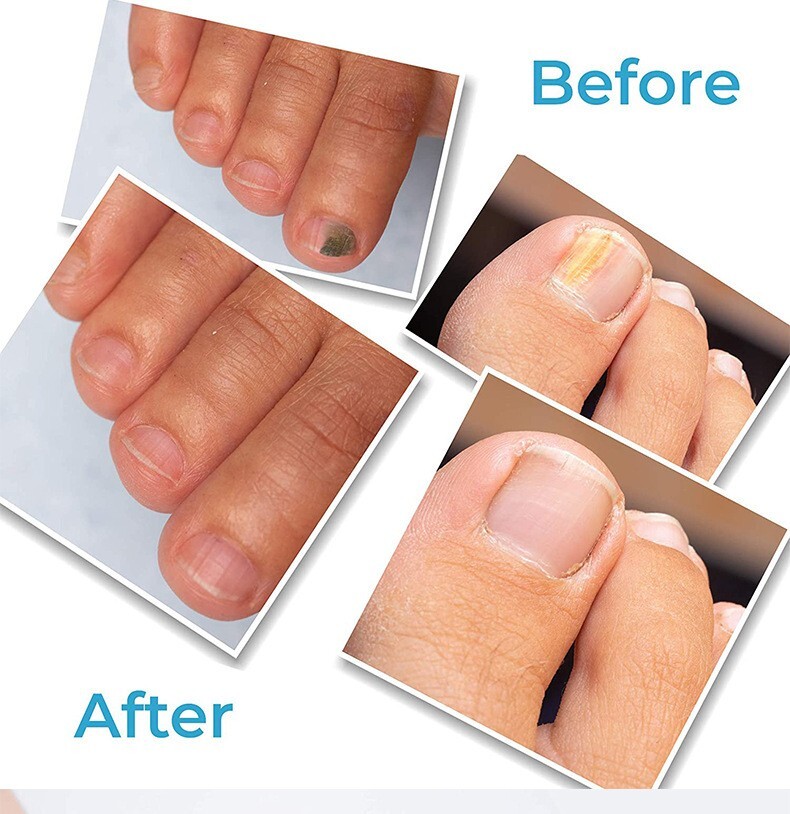 4Pcs Anti Fungal Treatment Extra Strength Toenail Fungus Foot Nail Repair Pen