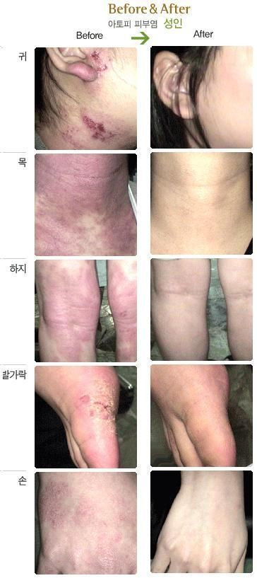 3 Lot of  ISAL Atopy Eczema Cream Lotion./Made in USA