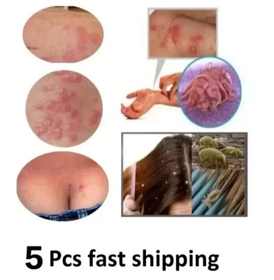 Lots of 5 Scabies cream 50 ml fast shipping