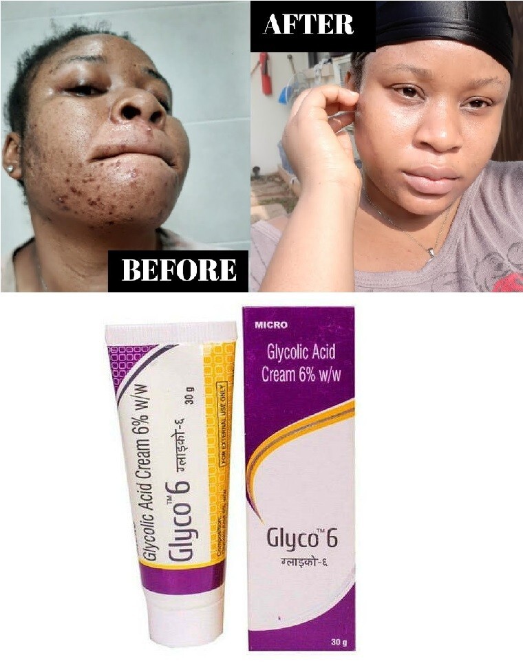 ( glycolic acid cream 6% 30g) ×5箱 Boppon Glyco 6 Cream with 6% Glycolic Acid - Pack of 2