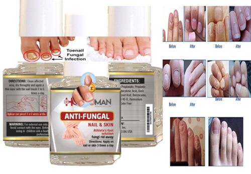 HONGO quick Best nail Fungal Killer FAST CURE BEST PRODUCT 4 CURE NAILS zana NEW