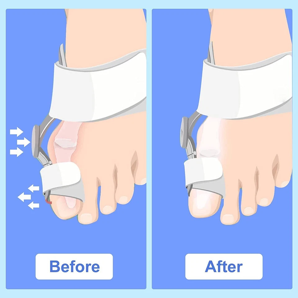 Bunion Splint Big Toe Straightener Corrector Knob Hallux Valgus Orthopedic Strap - Image 3 of 4