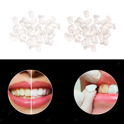  - Dünne Zahn Zähne Temporäre Veneers Oberharz Kit Zahnarzt Produkte