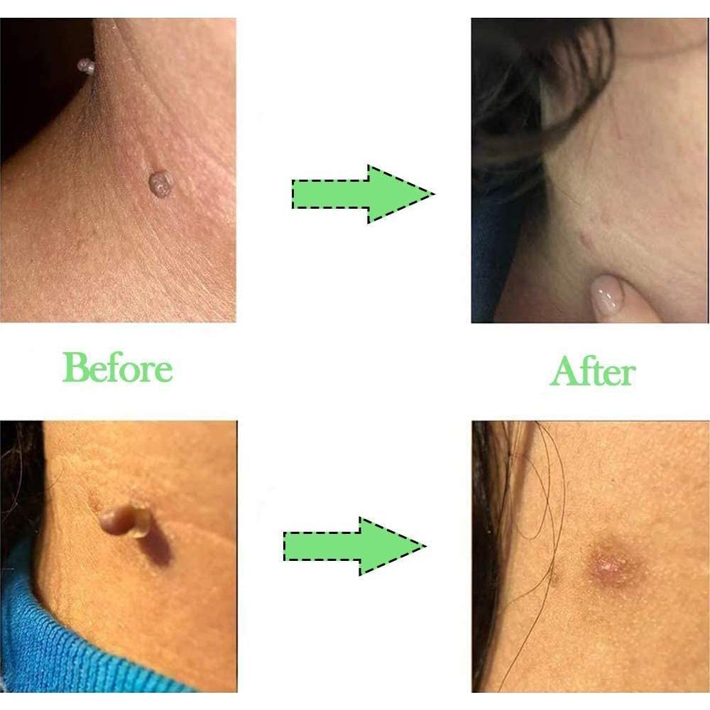 Skin Care Tools Skin Tag Removal Micro Band Rubber Bands Mole Wart Removal 793905317785 eBay