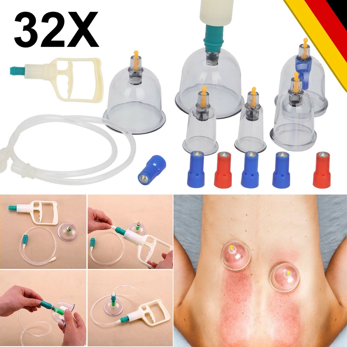 BACKLAxx® Schröpfgläser Set, 5 Glocken Mit Saugball 5 St - Shop Apotheke
